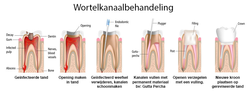 Wortelkanaalbehandeling - Tandartsenpraktijk Friedrich